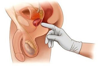 MAIGE PROSTATE