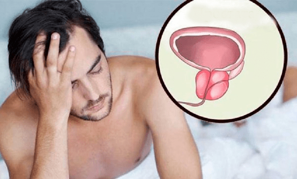 Sintomas de prostatite