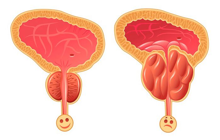 Próstata normal e inflamada