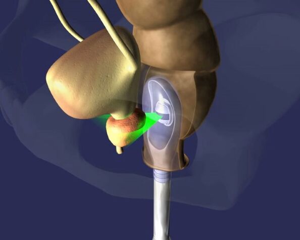 tratamento ultrassonográfico da próstata para prostatite