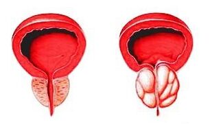 Próstata em estado normal (esquerda) e inflamada com prostatite (direita)