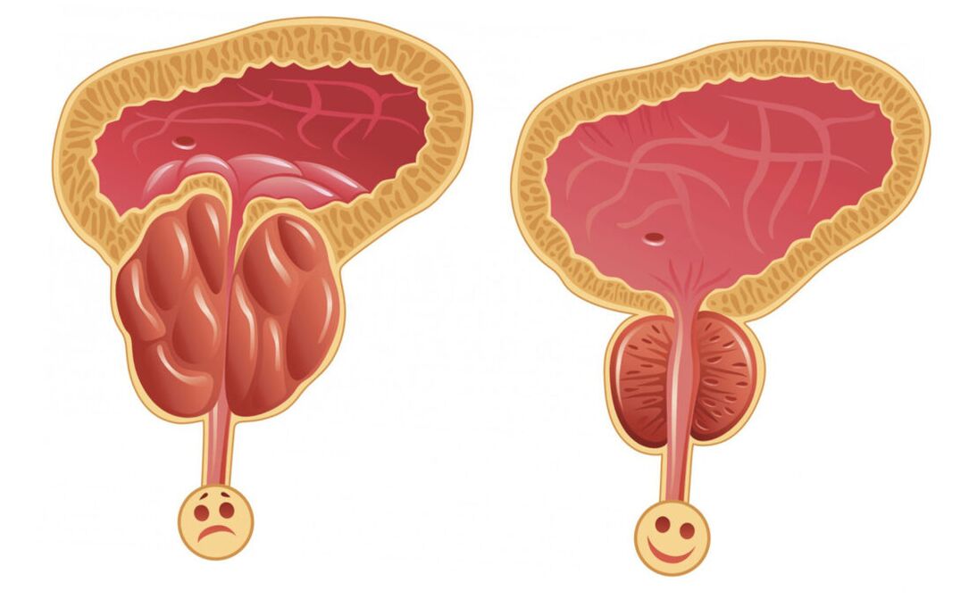 Inflamação da próstata com prostatite (esquerda) e a próstata é normal (direita)