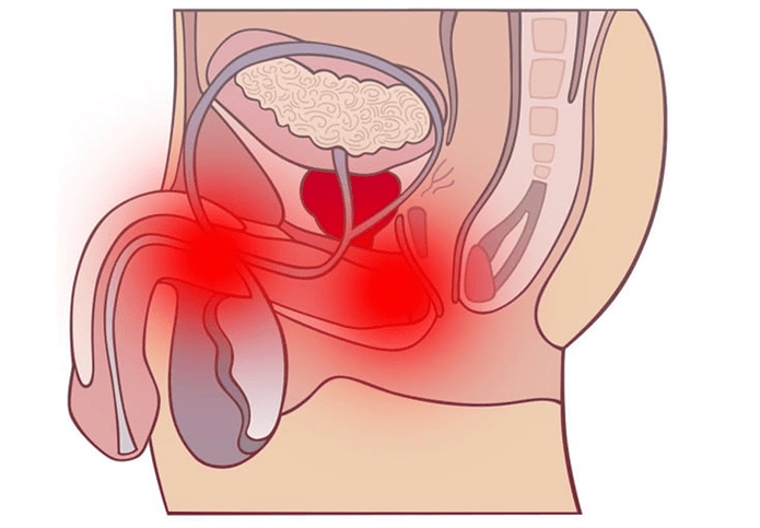 inflamação do trato genital com prostatite