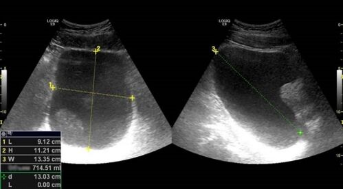 A ultrassonografia da próstata ajudará a diagnosticar prostatite em homens